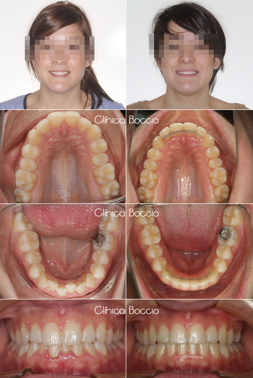 Casos ortodoncia invisalign en Huelva