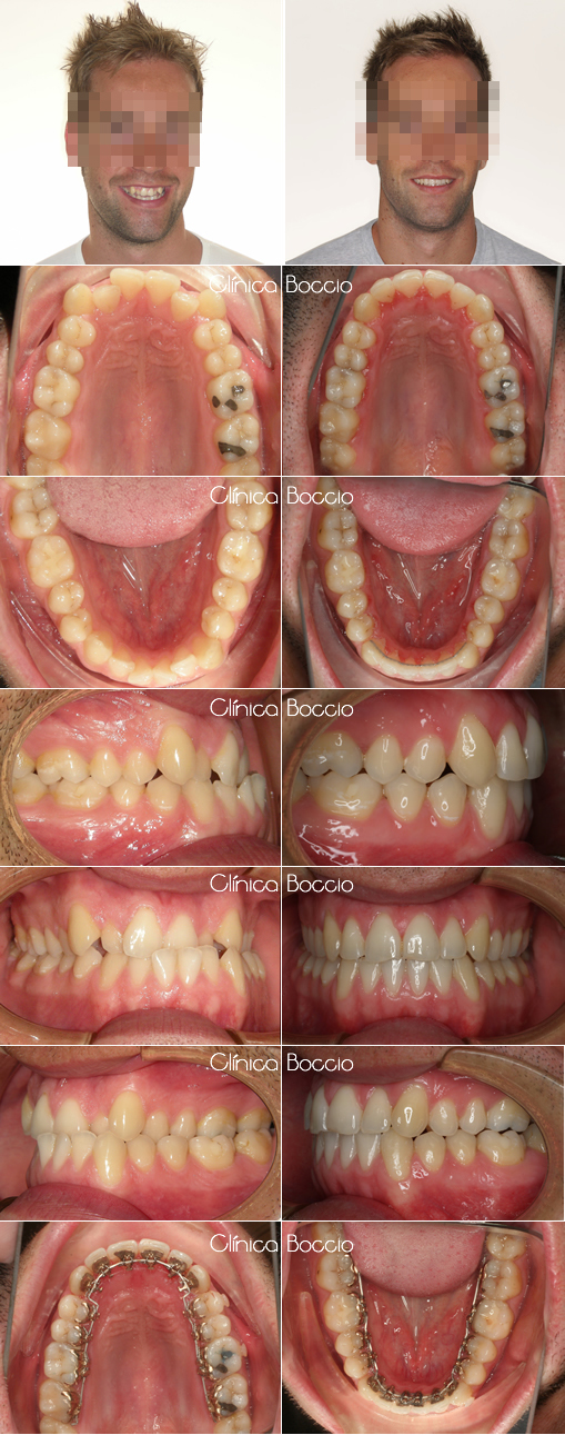 Casos ortodoncia lingual en Huelva