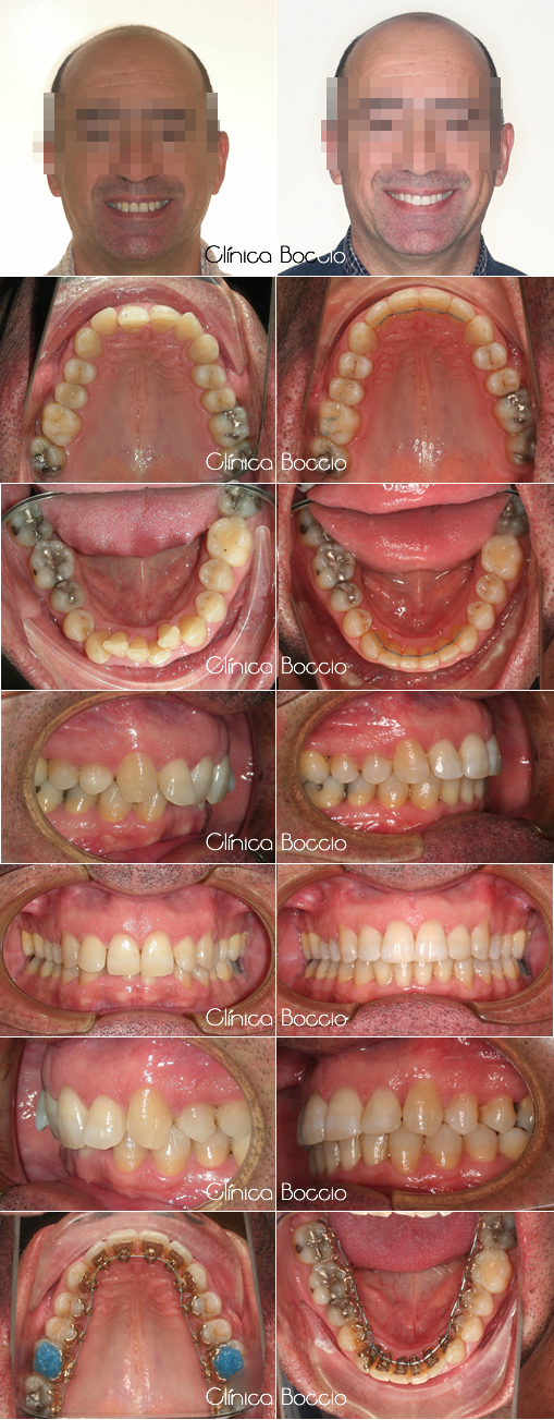 Casos ortodoncia lingual en Huelva
