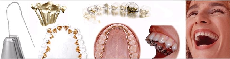 ortodoncia lingual clinica boccio huelva